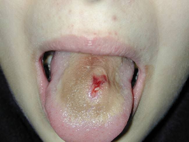infected tongue piercing Image