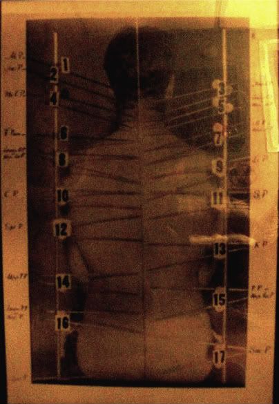 Chiropractic photo With the skin on